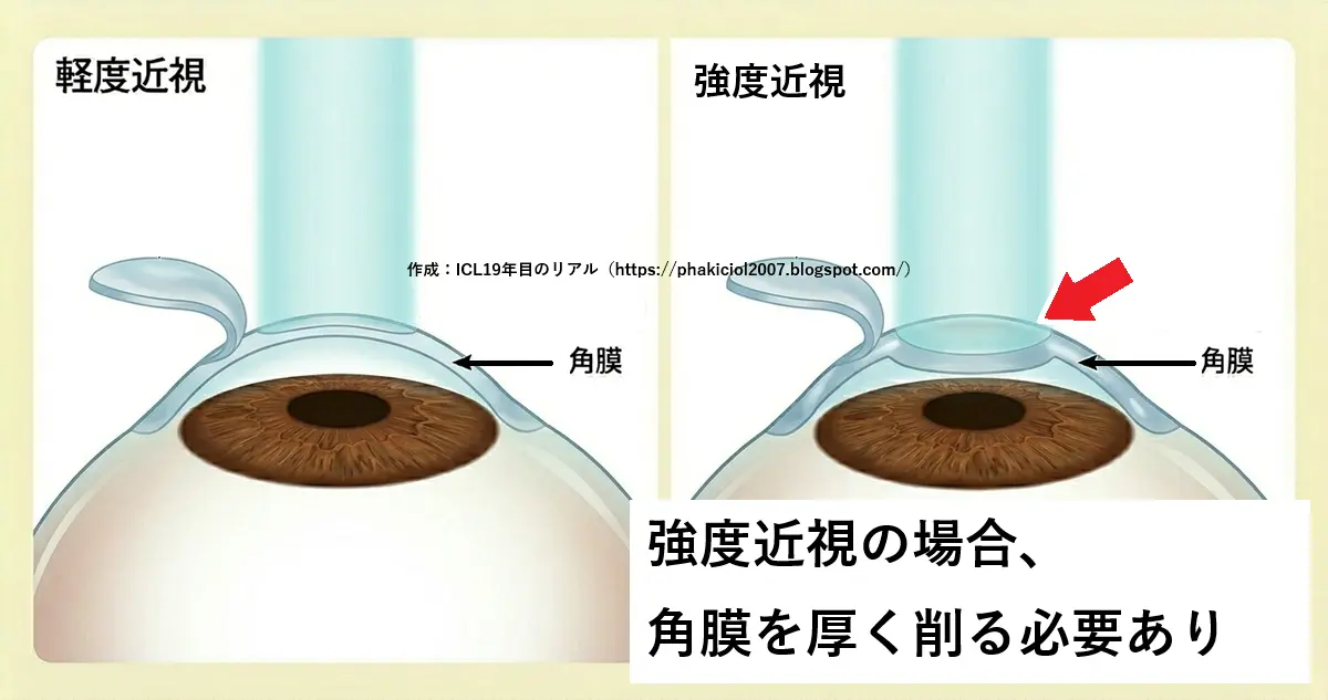 レーシックの仕組みと最強度近視｜ICL術後19年目のリアル